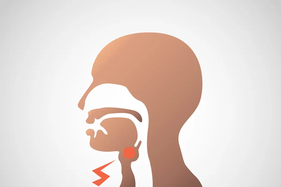 Illustrasjon av opphovnet sted i hals og svelg